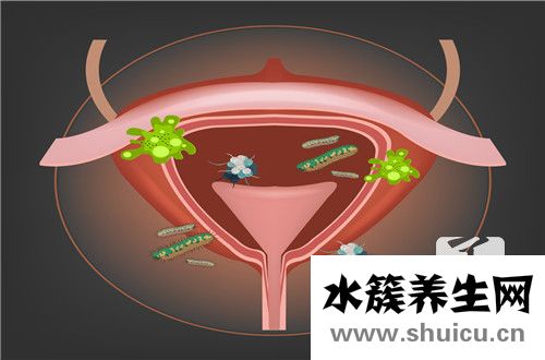 急性膀胱炎