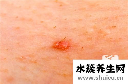 毛囊炎怎么辦