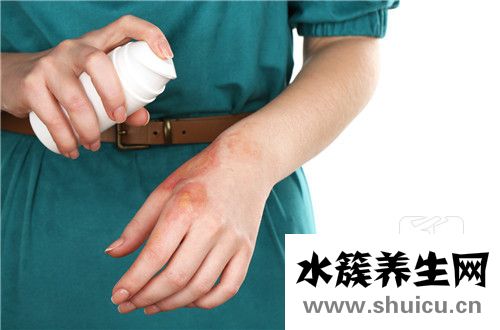 一度燙傷