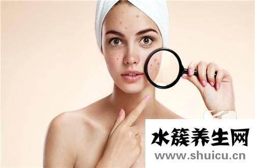 青春痘怎么處理