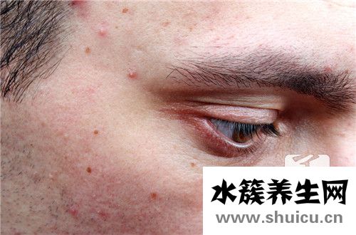 祛痘印小竅門