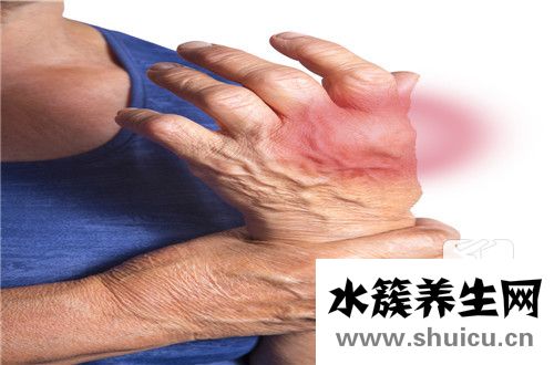 治療類風濕