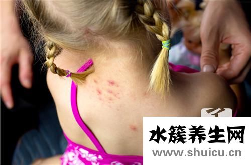 寶寶濕疹不能吃什么