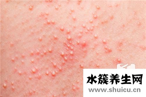 肛門小疙瘩