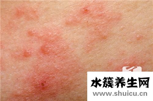 日光性皮炎癥狀