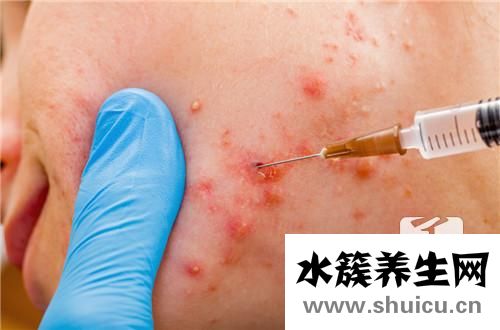 下巴長粉刺
