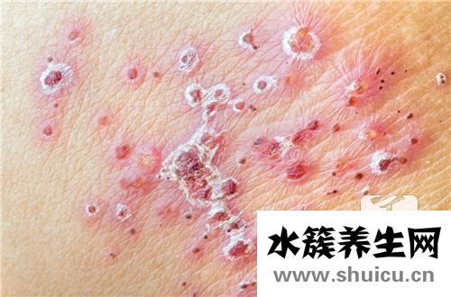 接觸性皮炎怎么治療
