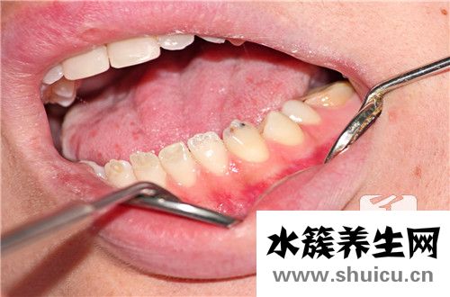 牙齒縫隙大