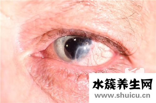 眼睛紅血絲
