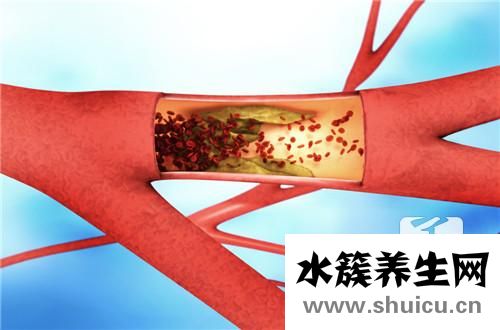 心臟動脈硬化