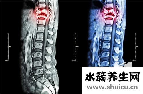硬脊膜囊受壓