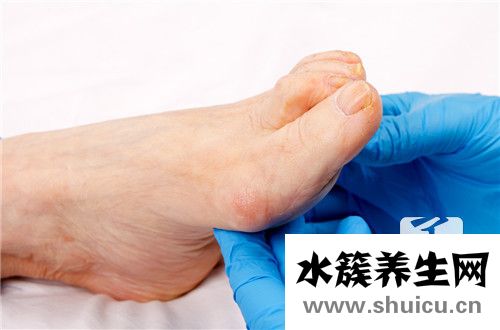 腳痛風治療