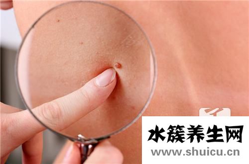 良性皮膚瘤同