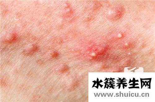 結節痘痘