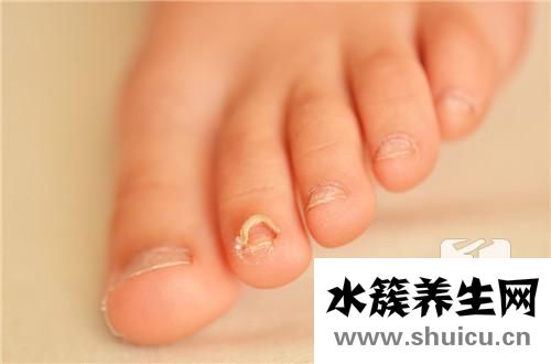 腳趾甲分層