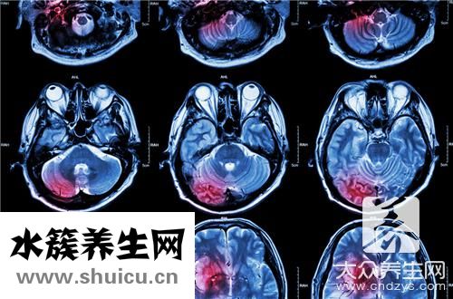 急性腦出血
