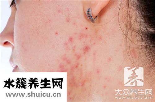 下巴周圍起痘痘