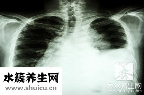 包裹性積液