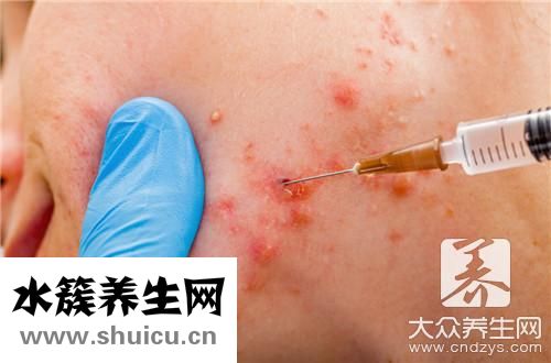 擠痘引發腦膜炎