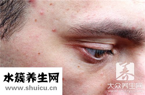 臉頰兩側長痘排毒
