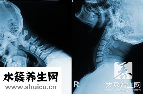 頸椎曲度后弓