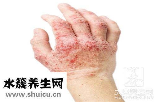 手部濕疹和手癬區別