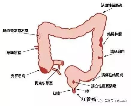 潰瘍性結腸炎怎么能根治，潰瘍性結腸炎怎么能根治好