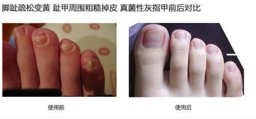 灰指甲怎么才能徹底根治，小朋友灰指甲怎么才能徹底根治