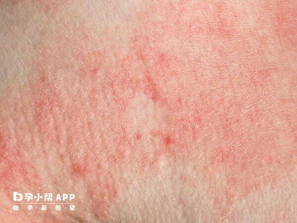 接觸性皮炎癥狀涂什么藥（接觸性皮炎癥狀圖片）