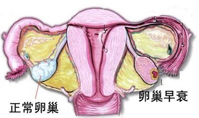 卵巢囊腫的現象有哪些（卵巢早衰的現象有哪些）
