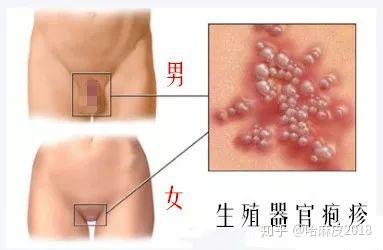 頭部皰疹圖片和癥狀圖片男性（皰疹圖片和癥狀圖片男性）