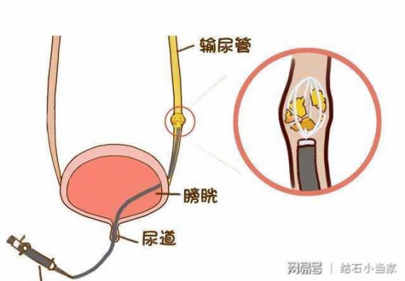 女性輸尿管結石最快的排出方法（輸尿管結石最快的排出方法）