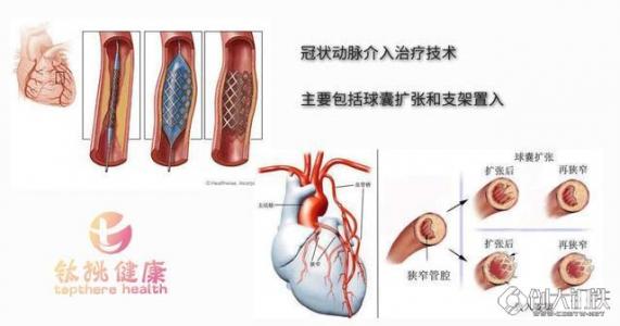 心臟心肌缺血的癥狀（心肌缺血的癥狀）