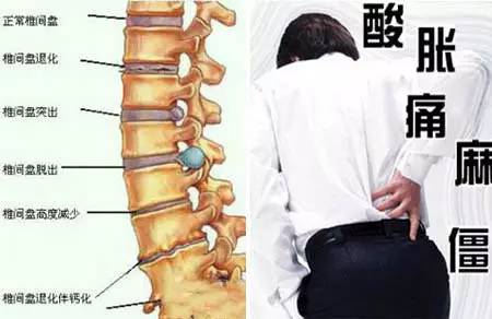腰椎間盤突出專用藥6種腰痹痛（腰椎間盤突出專用藥6種）