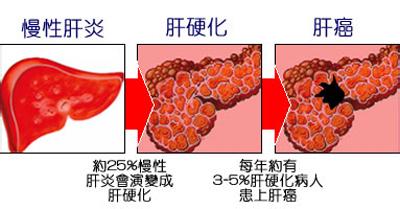 肝硬化的早期癥狀和前兆怎么治療（肝硬化的早期癥狀和前兆）