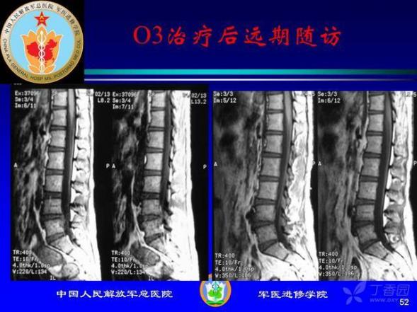 頸3一4一5一6一7椎間盤突出會頭暈嗎（頸3一4一5一6一7椎間盤突出）