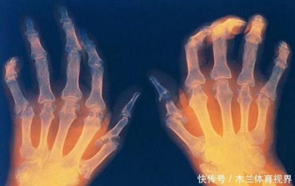風濕病怎么治療才可以徹底治好中醫（風濕病怎么治療才可以徹底治好）