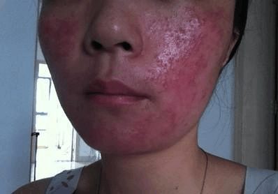 面部皮膚過敏圖片和癥狀圖片大全外國女人圖片（面部皮膚過敏圖片）
