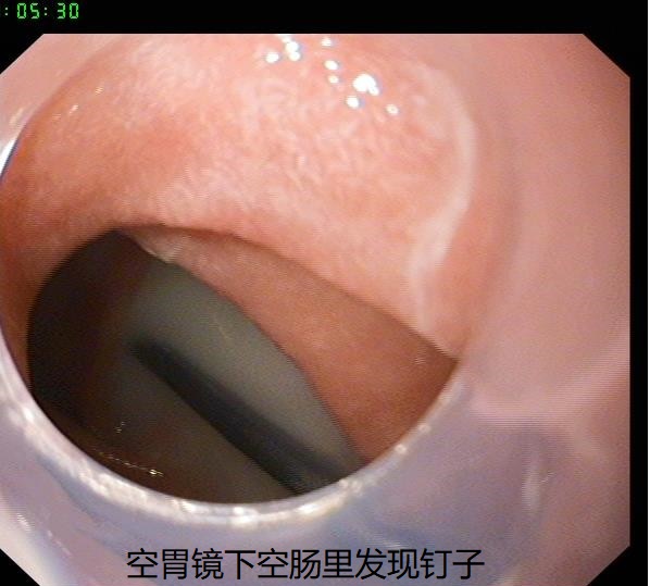 胃鏡怎么做的過程視頻（做胃鏡的全過程圖）