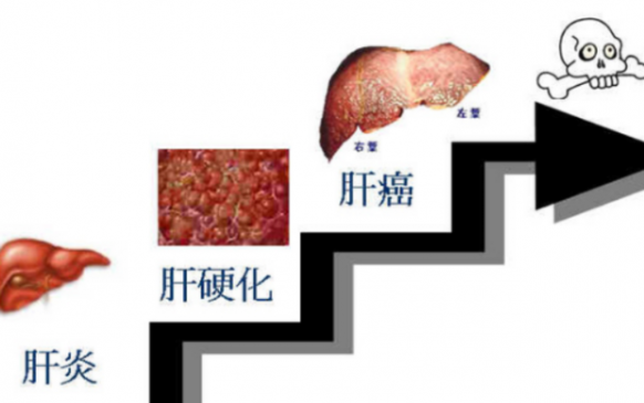 肝癌晚期臨死七大癥狀（肝癌晚期瀕臨死亡患者的現狀）