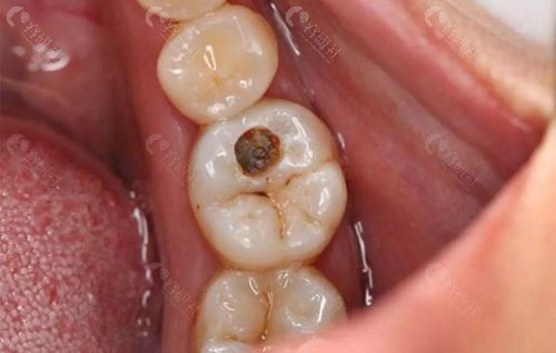 牙齒爛了一個洞很痛怎么辦（牙齒爛了一個洞很痛怎么辦緩解）