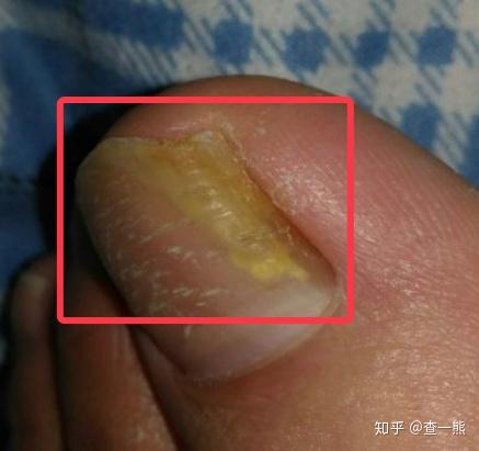 指甲感染真菌的早期圖片（指甲真菌感染能自愈嗎）