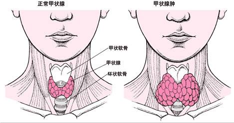 女性甲狀腺自檢方法（甲減）