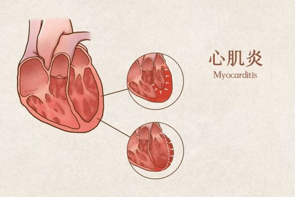 兒童心肌炎的早期癥狀和前兆（小孩心肌炎自測15秒方法）