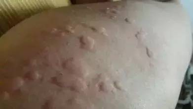 疥瘡的克星（疥瘡的克星是什么藥）