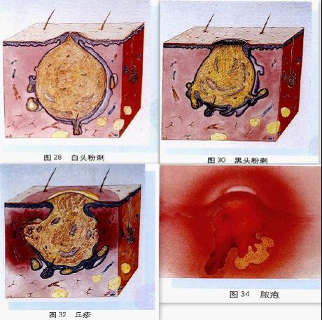 下面腥臭味一放甲硝唑就好（用了甲硝唑后里面長滿了霉菌）