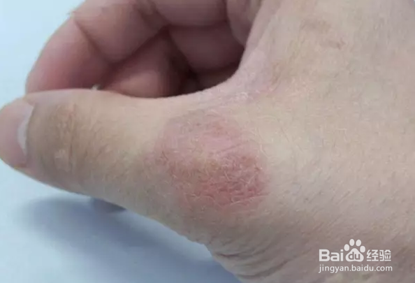 怎么判斷是不是疥瘡（怎么判斷是不是疥瘡和濕疹）
